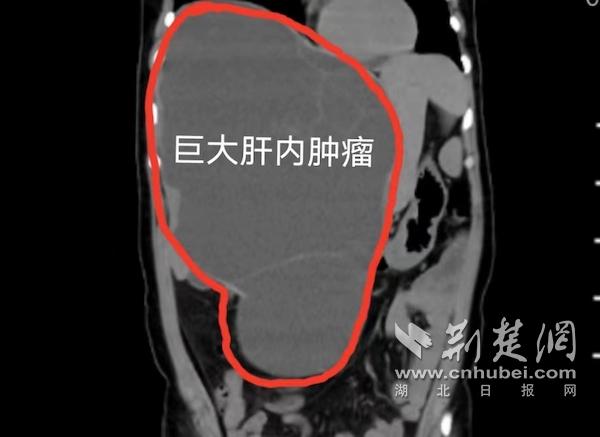 巨大肝内肿瘤.jpg
