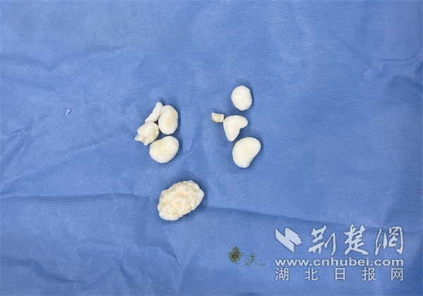 手术取出的关节游离体 (1).jpg