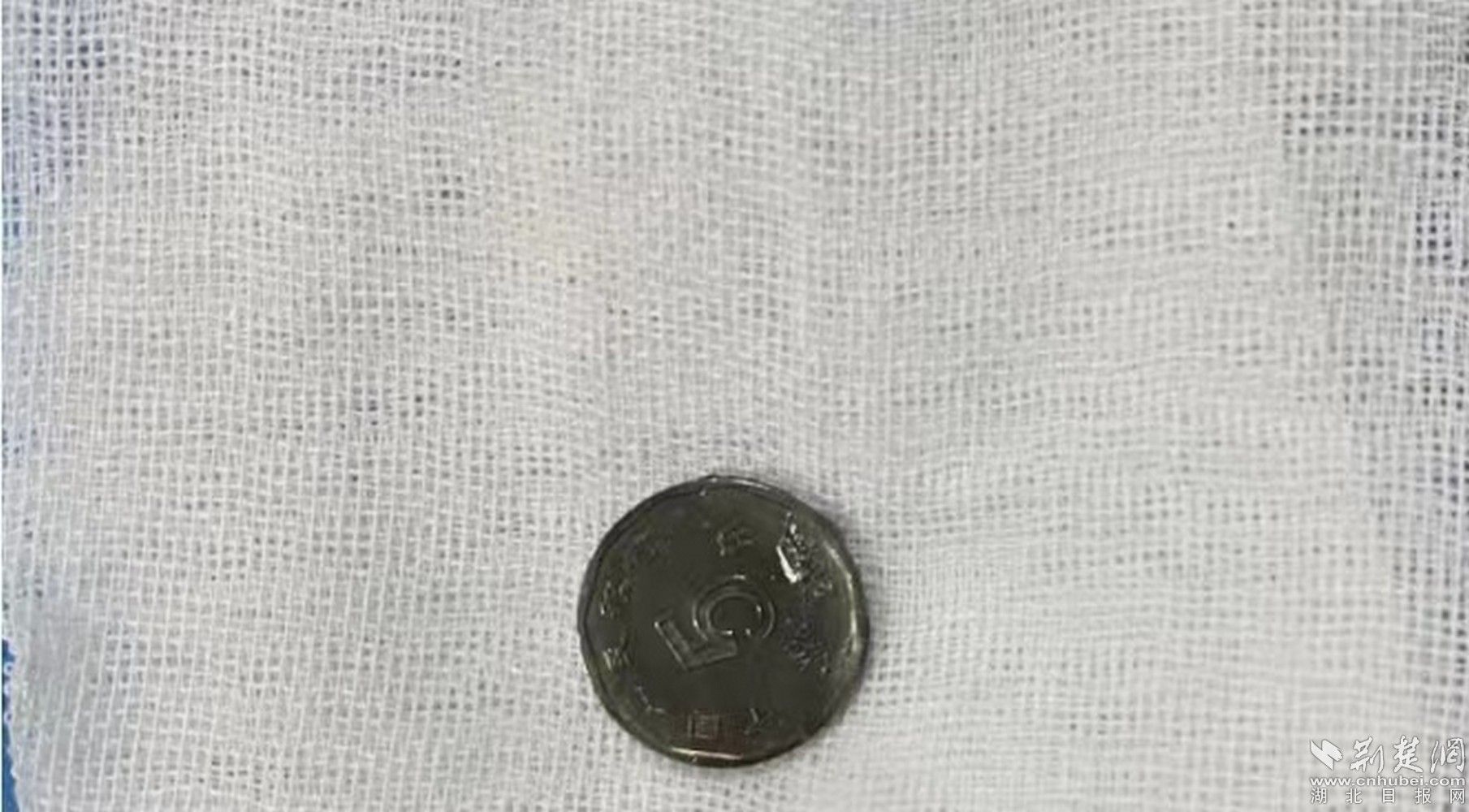 8岁男孩误吞硬币，医生5分钟微创取出